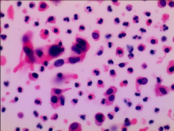 尿液液基细胞学---HE染色图10