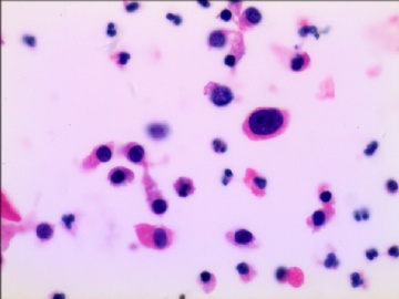 尿液基制片（很典型的病例）图1