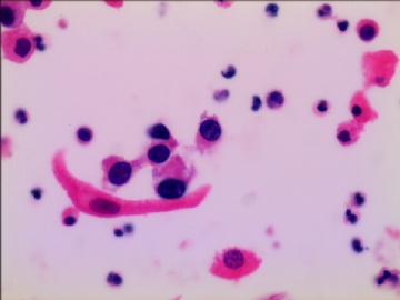 尿液基制片（很典型的病例）图3