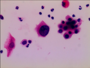 尿液基制片（很典型的病例）图4