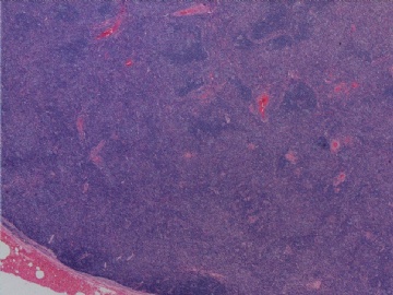 左腹股沟淋巴结(反应性增生或某类淋巴瘤？已上传IHC图片)(2010-8-31)图1