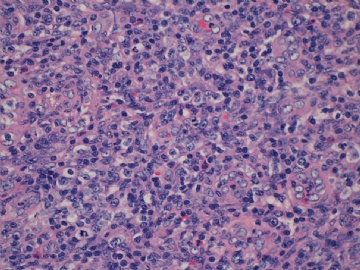 左腹股沟淋巴结(反应性增生或某类淋巴瘤？已上传IHC图片)(2010-8-31)图3