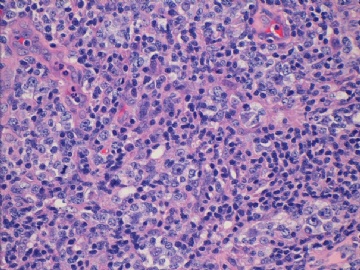左腹股沟淋巴结(反应性增生或某类淋巴瘤？已上传IHC图片)(2010-8-31)图4
