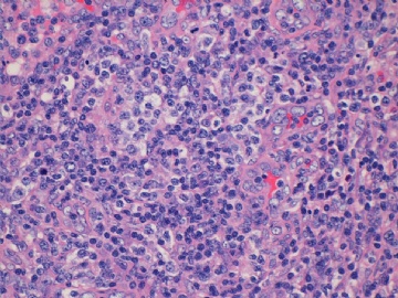 左腹股沟淋巴结(反应性增生或某类淋巴瘤？已上传IHC图片)(2010-8-31)图5