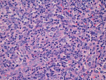 左腹股沟淋巴结(反应性增生或某类淋巴瘤？已上传IHC图片)(2010-8-31)图6
