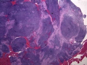 男性/15岁，骶骨肿瘤，影像学诊断Langerhan's Histiocytosis ，IHC10-9-5图1