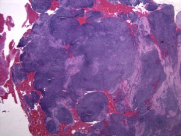 男性/15岁，骶骨肿瘤，影像学诊断Langerhan's Histiocytosis ，IHC10-9-5图2