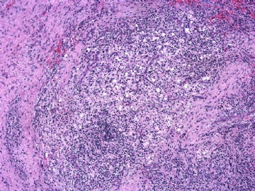 男性/15岁，骶骨肿瘤，影像学诊断Langerhan's Histiocytosis ，IHC10-9-5图3