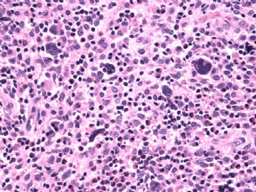 男性/15岁，骶骨肿瘤，影像学诊断Langerhan's Histiocytosis ，IHC10-9-5图4