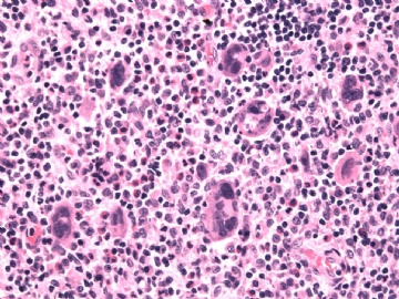 男性/15岁，骶骨肿瘤，影像学诊断Langerhan's Histiocytosis ，IHC10-9-5图5