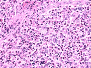 男性/15岁，骶骨肿瘤，影像学诊断Langerhan's Histiocytosis ，IHC10-9-5图6