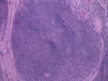 男性/15岁，骶骨肿瘤，影像学诊断Langerhan's Histiocytosis ，IHC10-9-5图7