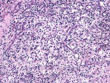 男性/15岁，骶骨肿瘤，影像学诊断Langerhan's Histiocytosis ，IHC10-9-5图8