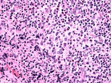 男性/15岁，骶骨肿瘤，影像学诊断Langerhan's Histiocytosis ，IHC10-9-5图9