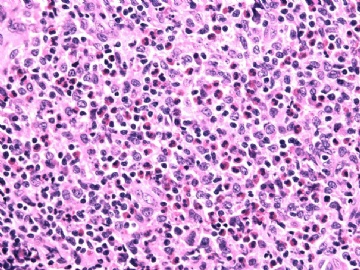 男性/15岁，骶骨肿瘤，影像学诊断Langerhan's Histiocytosis ，IHC10-9-5图10