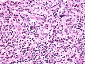 男性/15岁，骶骨肿瘤，影像学诊断Langerhan's Histiocytosis ，IHC10-9-5图11