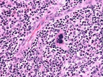 男性/15岁，骶骨肿瘤，影像学诊断Langerhan's Histiocytosis ，IHC10-9-5图12
