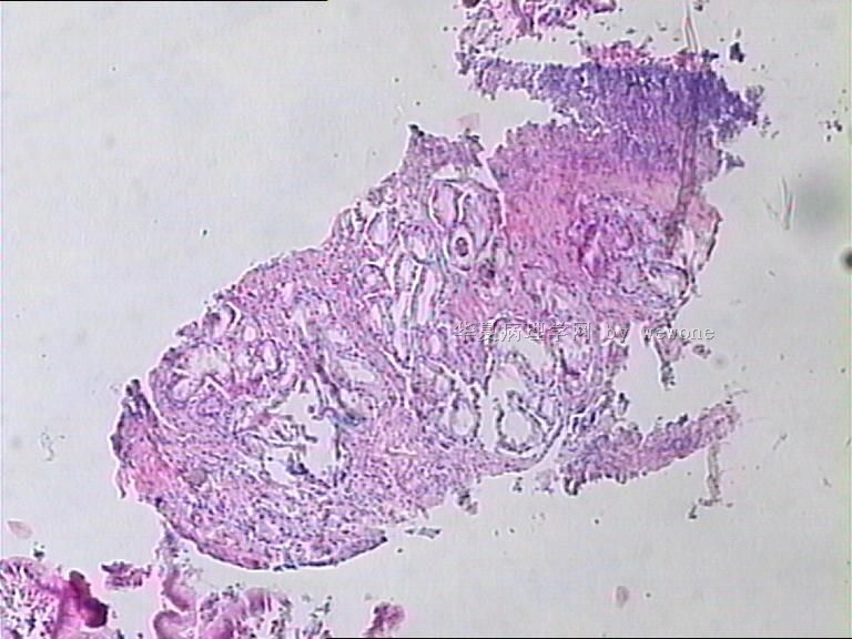 胃体溃疡活检。  奇怪？？？请老师们帮忙看看，谢谢。图1