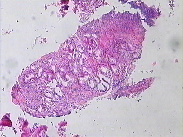 胃体溃疡活检。  奇怪？？？请老师们帮忙看看，谢谢。图2