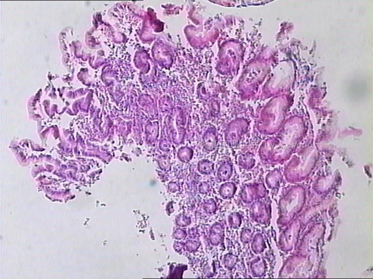 胃体溃疡活检。  奇怪？？？请老师们帮忙看看，谢谢。图3