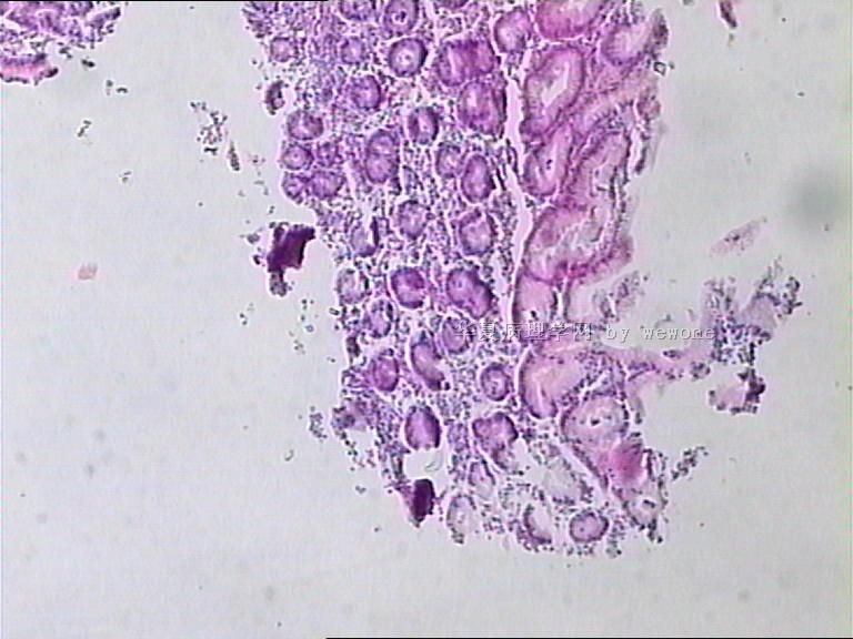 胃体溃疡活检。  奇怪？？？请老师们帮忙看看，谢谢。图4