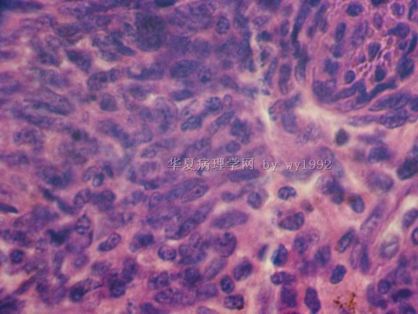 201008837子宫肌瘤(有最后结果)图14