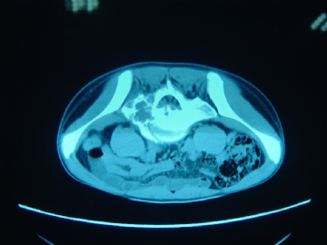 男性/15岁，骶骨肿瘤，影像学诊断Langerhan's Histiocytosis ，IHC10-9-5图16