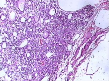 甲状腺肿物图13