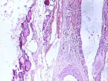 甲状腺肿物图14