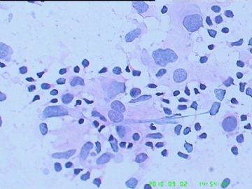 颌下肿物穿刺涂片，淋巴瘤？混合瘤？图9