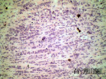 双侧乳腺、双侧甲状腺冰冻图6