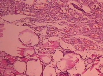 这个宫颈癌患者的卵巢，里面有甲状腺组织，是异位？图1