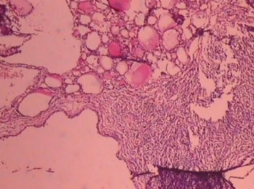 这个宫颈癌患者的卵巢，里面有甲状腺组织，是异位？图2