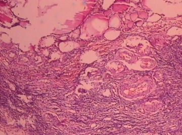 这个宫颈癌患者的卵巢，里面有甲状腺组织，是异位？图3
