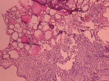这个宫颈癌患者的卵巢，里面有甲状腺组织，是异位？图4