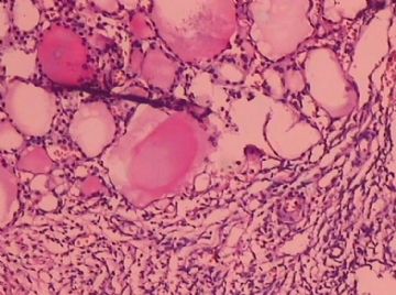 这个宫颈癌患者的卵巢，里面有甲状腺组织，是异位？图5