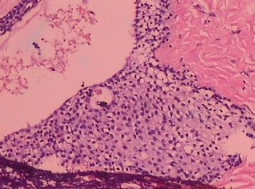 这个宫颈癌患者的卵巢，里面有甲状腺组织，是异位？图8