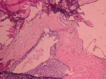 这个宫颈癌患者的卵巢，里面有甲状腺组织，是异位？图9