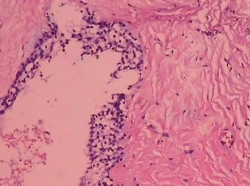 这个宫颈癌患者的卵巢，里面有甲状腺组织，是异位？图10
