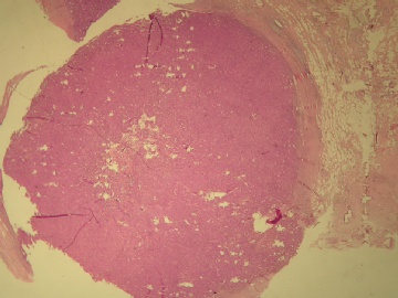 乳腺肿块（20100914）--请看免疫组化图片！----浸润性乳头状癌??图1