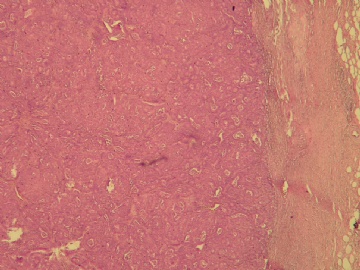 乳腺肿块（20100914）--请看免疫组化图片！----浸润性乳头状癌??图2