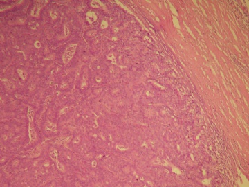 乳腺肿块（20100914）--请看免疫组化图片！----浸润性乳头状癌??图3