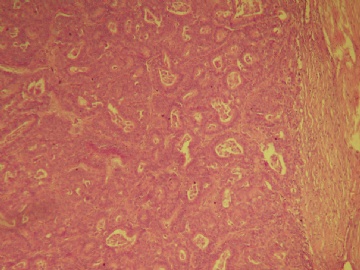 乳腺肿块（20100914）--请看免疫组化图片！----浸润性乳头状癌??图4
