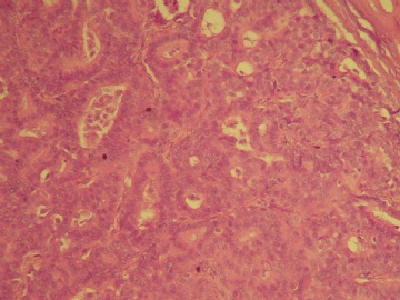乳腺肿块（20100914）--请看免疫组化图片！----浸润性乳头状癌??图5