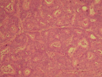 乳腺肿块（20100914）--请看免疫组化图片！----浸润性乳头状癌??图6