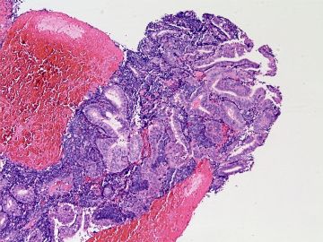 子宫内膜病例-地坛图4