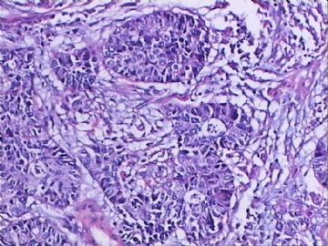 宫颈基底细胞样鳞癌图8