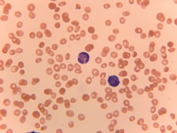 27 Year-old male with increased WBC图1