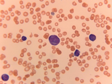 27 Year-old male with increased WBC图3