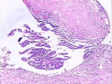 交界性浆液性囊腺瘤？囊腺癌？交界性局部癌变?图1